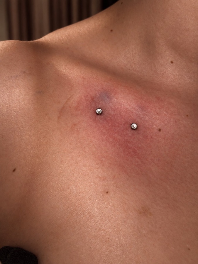 Microdermal